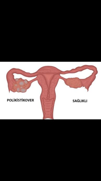 Poli̇ki̇sti̇k Over Nedir, Nasıl Tanınır?