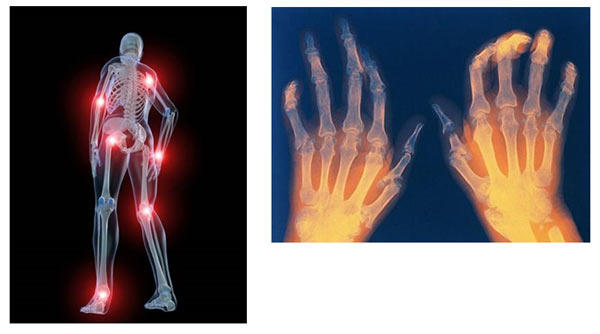 Romatoid Artrit Nedir?
