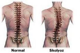 Skolyoz Hastalığı Nedir, Tedavisi Nasıl Olmalıdır?