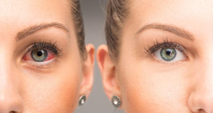 Üveit Hastalığı Nedir? Belirtileri Ve Tedavi Yöntemleri Nelerdir?