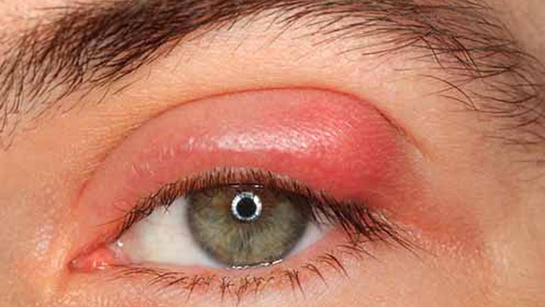 Üveit Hastalığı Nedir? Belirtileri Ve Tedavi Yöntemleri Nelerdir?