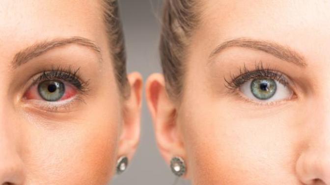 Üveit Hastalığı Nedir? Belirtileri Ve Tedavi Yöntemleri Nelerdir?