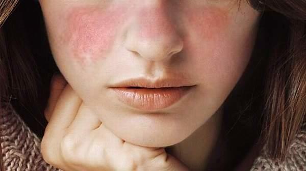 Kelebek Hastalığı (Lupus) Nedir? Belirtileri ve Tedavi Yöntemleri Nelerdir?