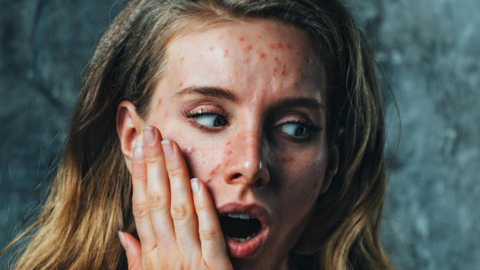 Kelebek Hastalığı (Lupus) Nedir? Belirtileri ve Tedavi Yöntemleri Nelerdir?