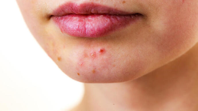 Kelebek Hastalığı (Lupus) Nedir? Belirtileri ve Tedavi Yöntemleri Nelerdir?