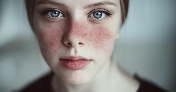 Kelebek Hastalığı (Lupus) Nedir? Belirtileri ve Tedavi Yöntemleri Nelerdir?