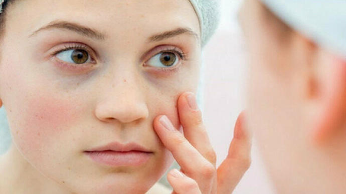 Kelebek Hastalığı (Lupus) Nedir? Belirtileri ve Tedavi Yöntemleri Nelerdir?
