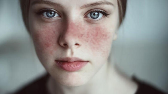 Kelebek Hastalığı (Lupus) Nedir? Belirtileri ve Tedavi Yöntemleri Nelerdir?