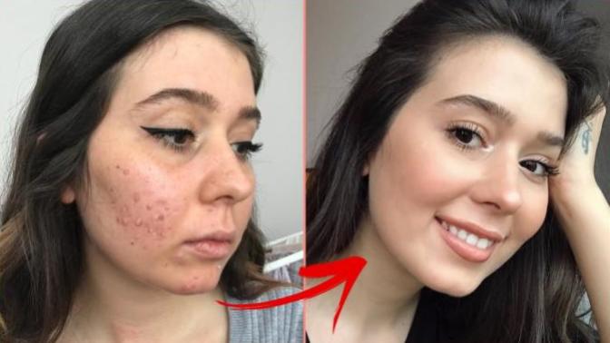Roaccutane Süreci: Neler Yaşanıyor, Sanıldığı Kadar Korkunç mu?
