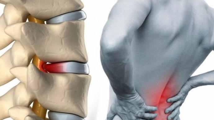 Ağrısı Kendisinden Kötü Olan Hastalık: Lumbal Disk Hernisi