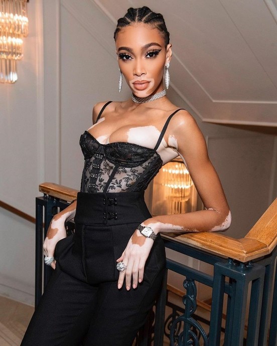 Klişe Güzellik Algılarını Sabri Misali Saha Dışına Yollayan Bir Melek: Winnie Harlow!