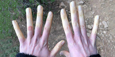 Zombi Gibi Eller: Raynaud Fenomeni!