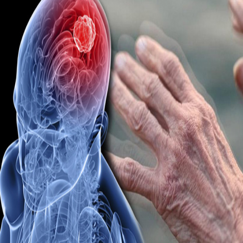 Parkinson Nedir, Bu Hastalığa Göz Atalım mı?