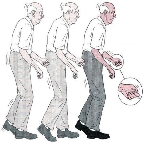Parkinson Nedir, Bu Hastalığa Göz Atalım mı?