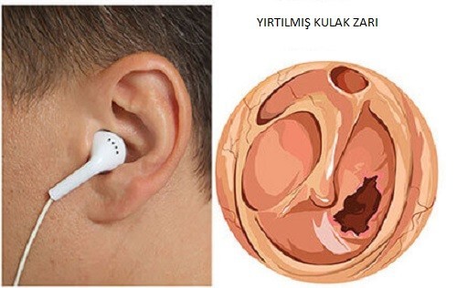 Yüksek sesle müzik dinlendiği için yırtılmış bir kulak zarı