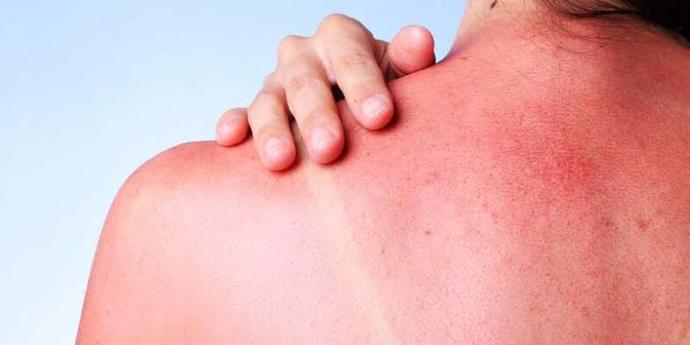 Özellikle Yaz Mevsiminin Kabusu; Güneş Alerjisi Hakkında Bilgiler