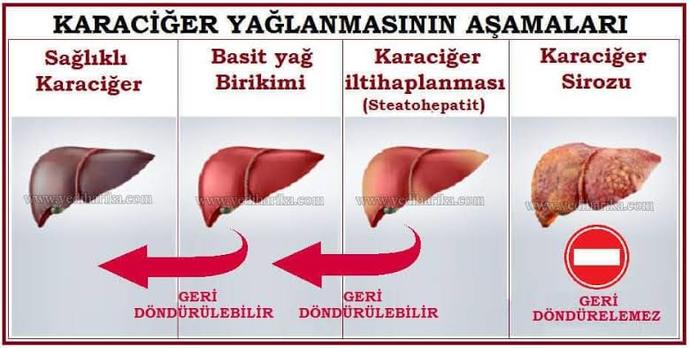 Karaciğer Yağlanması Aşamaları