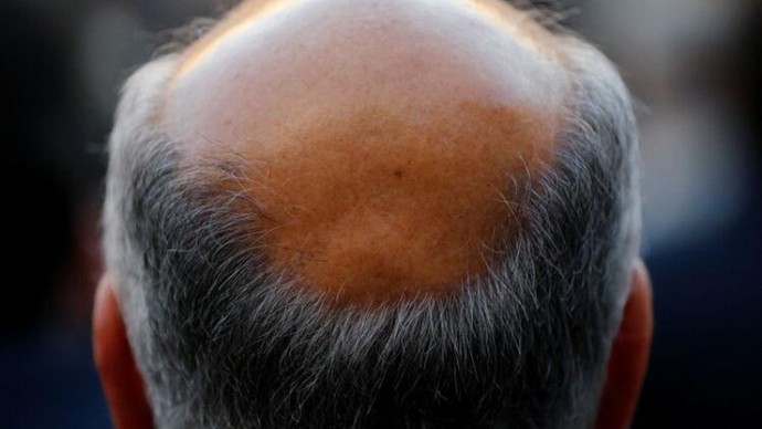 Saçlarımız Neden Kalıcı Olarak Dökülür? Bilimsel Yönden Açıklıyorum!