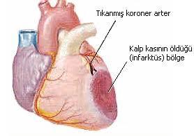 Kalp Krizi Neden Olur? Riskleri En Aza İndirelim!