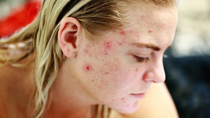 Eczanede Satılan En Etkili Sivilce Savarlar