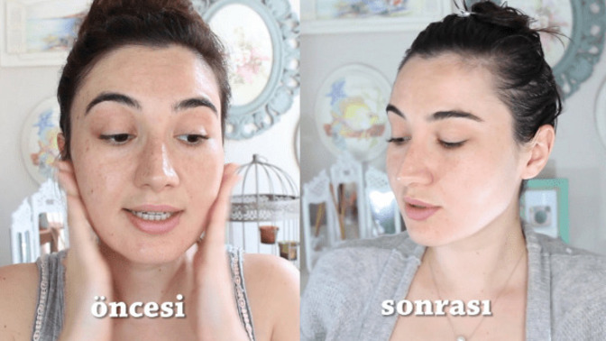 Expigment Krem Nedir? Ne İşe Yarar?