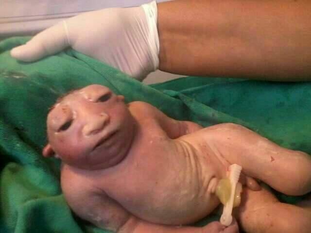 Anensefalik bir bebek.