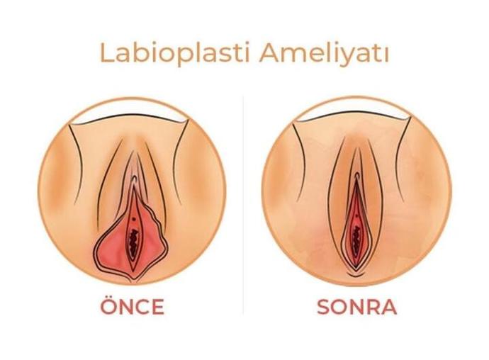 labioplasti ameliyatı öncesi sonrası