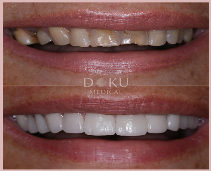 Kusursuz Gülümsemeye Ulaşmanın Sırrı: Hollywood Smile