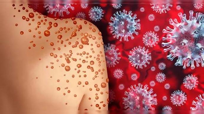 Dünya Sağlık Örgütünün Alarm Verdiği Maymun Çiçeği Virüsü Nedir?