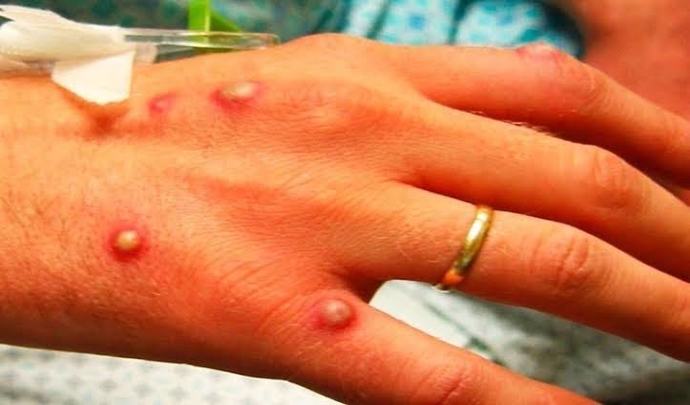 Dünya Sağlık Örgütünün Alarm Verdiği Maymun Çiçeği Virüsü Nedir?