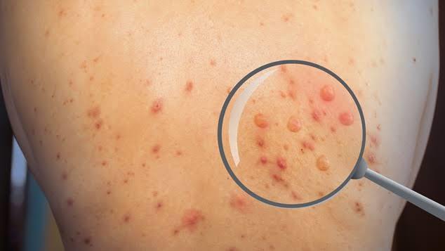 Dünya Sağlık Örgütünün Alarm Verdiği Maymun Çiçeği Virüsü Nedir?