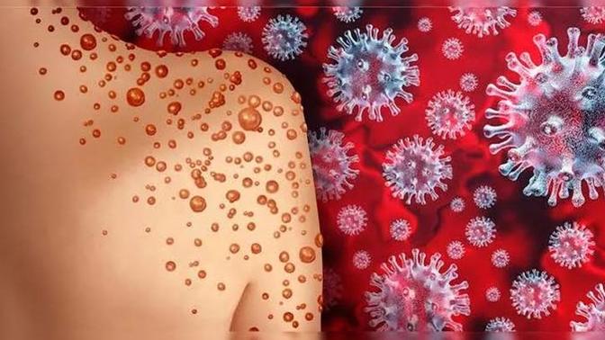 Dünya Sağlık Örgütü'nün Alarm Verdiği Maymun Çiçeği Virüsü Nedir?