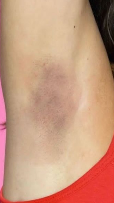 Ciltteki Kararma ve Lekeler İçin Öneriler