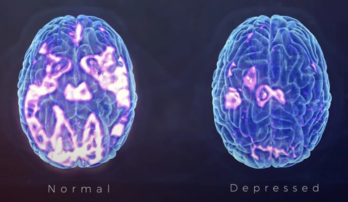 Depresyon yaşayan bir bireyin ve yaşamayan bir bireyin beyinlerinde elektriksel aktivitenin görüntüsü