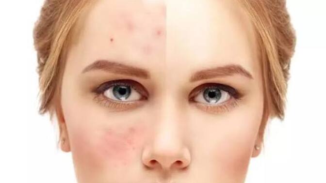 Temiz Cilt Mümkün Bunun İçin Sivilcelerle Savaş! Sivilcelerle Savaşmanın En Etkili Yolu!