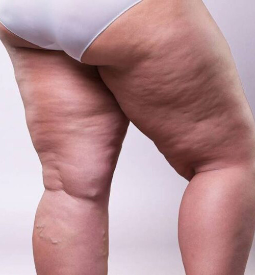 Lipodem İçin İdeal Beslenme