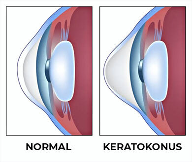 Keratokonus Nedir, Ne Değildir? Benim 25 Yıllık Göz Hikâyem