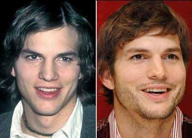 Burun Estetiği Ameliyat Öncesi ve Sonrası