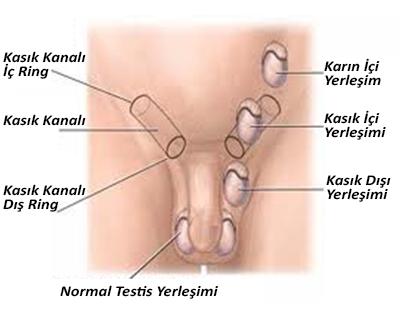 Testis Kanserinden korunmak .