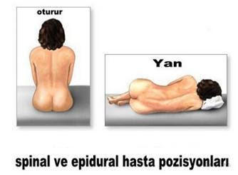Spinal Anestezi ve Baş Ağrısı