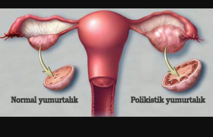 Yumurtalık Kistleri ve Çeşitleri