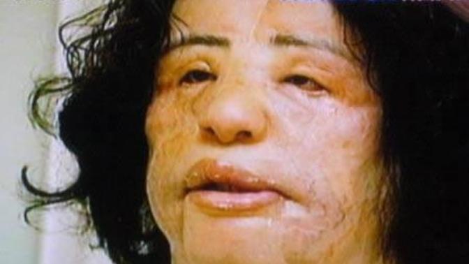 Estetik Faciaları