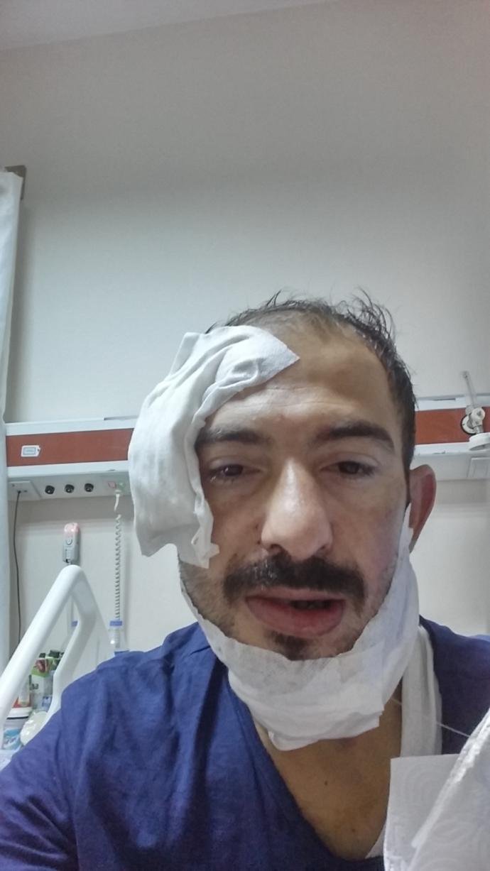 Dünyanın En Zor Ameliyatı Olan Çene Ameliyatı - Jaw Surgery