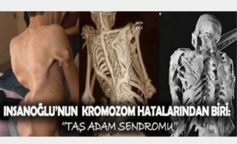 Dünyada Nadir Görülen Hastalıklar