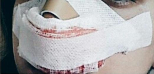 Estetik Burun Ameliyatı Hakkındaki Deneyimlerim