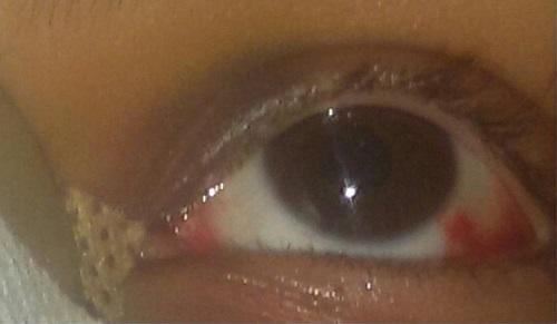 Estetik Burun Ameliyatı Hakkındaki Deneyimlerim