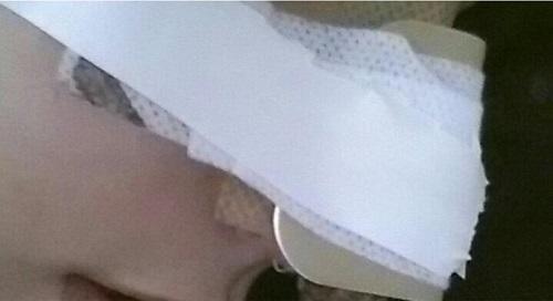 Estetik Burun Ameliyatı Hakkındaki Deneyimlerim