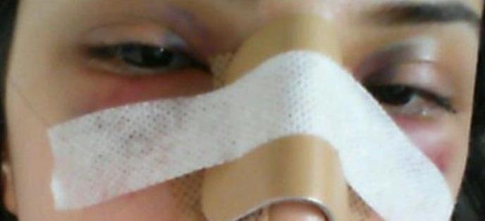 Estetik Burun Ameliyatı Hakkındaki Deneyimlerim