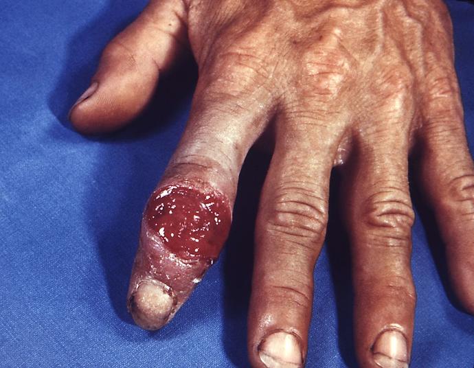 Kadınlar için Bulaşıcı Genital Hastalıklar Klavuzu