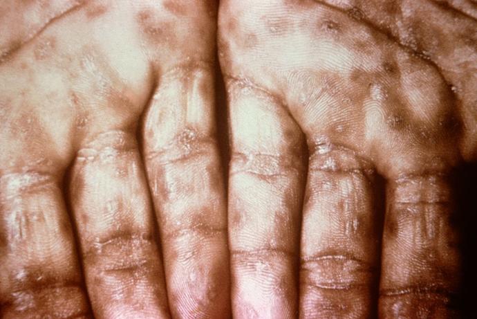 Kadınlar için Bulaşıcı Genital Hastalıklar Klavuzu